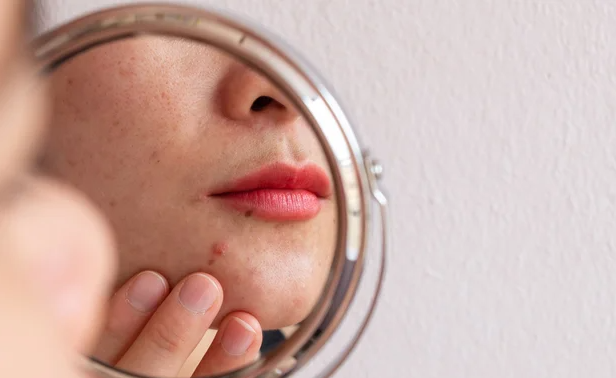 Can BCAA Cause Acne.png